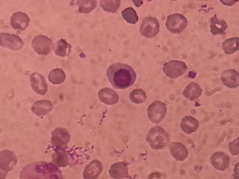 Iron Deficiency Anemia clinical reference photography