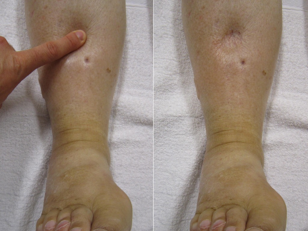 Clinical diagnostic examination of lower leg pitting peripheral edema and swollen ankles