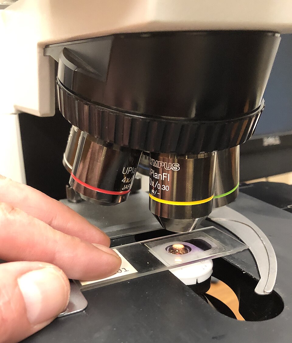 Malaria clinical reference photography