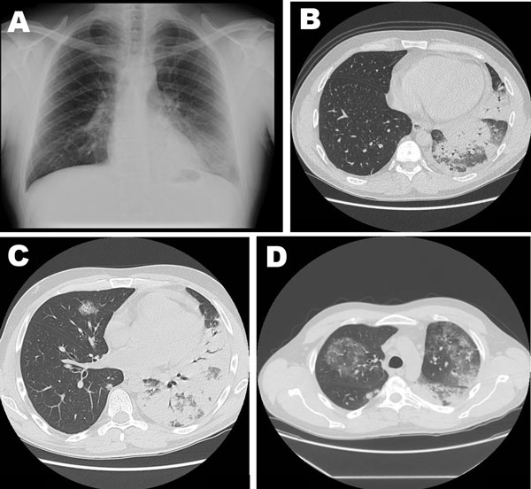 Pneumonia clinical reference photography