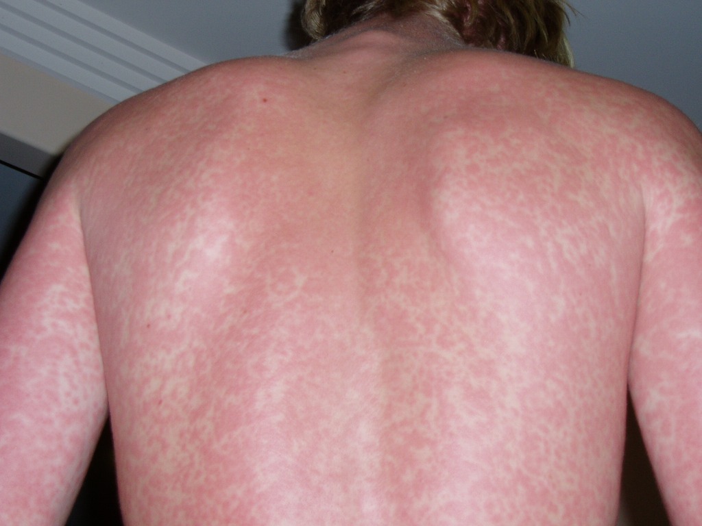 Clinical view of widespread itchy red allergic skin rash and erythematous hives